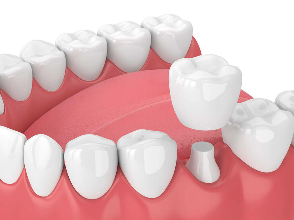 illustration of dental crowns and bridges