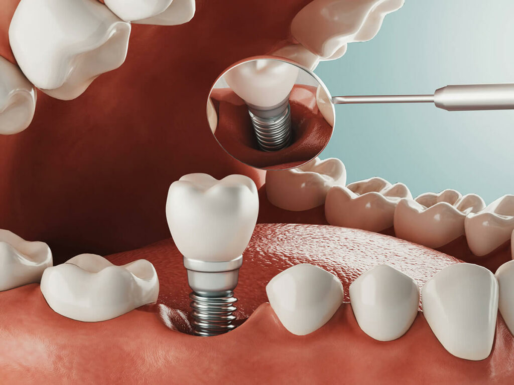 3d rendering of dental implants procedure