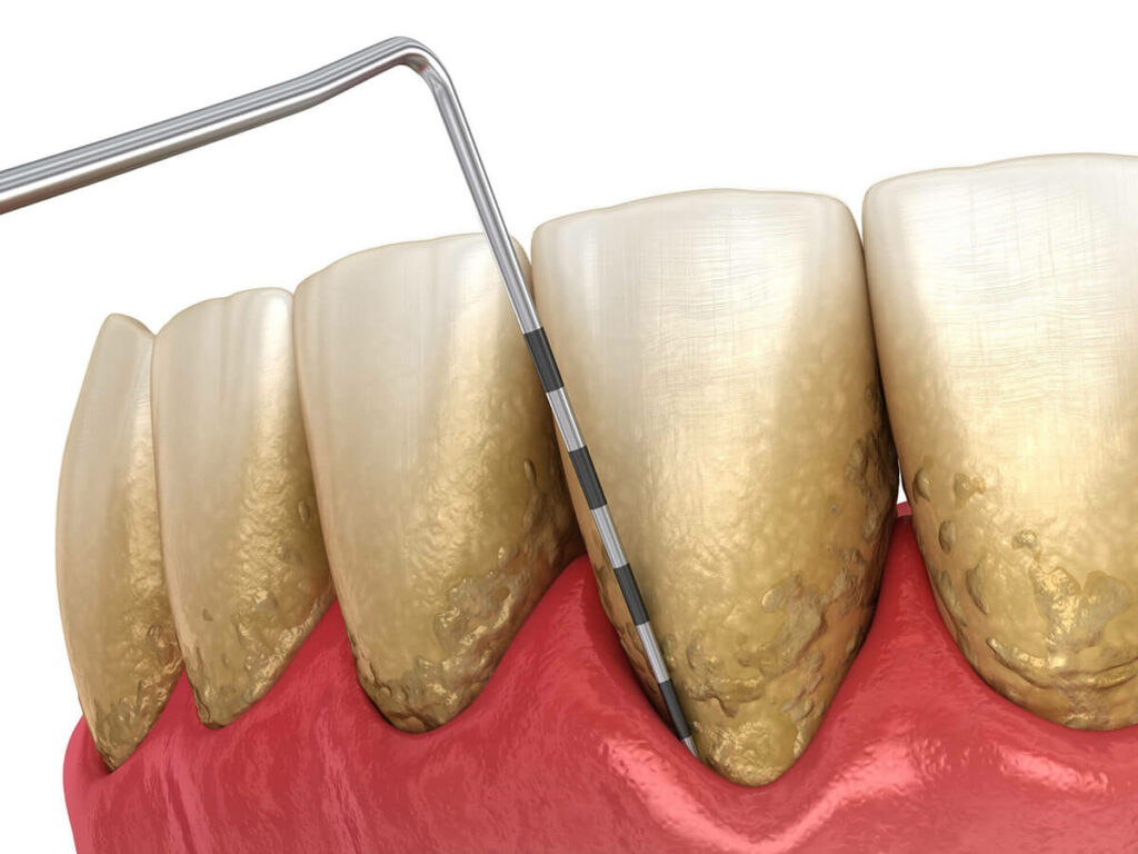 illustration of teeth with plaque buildup