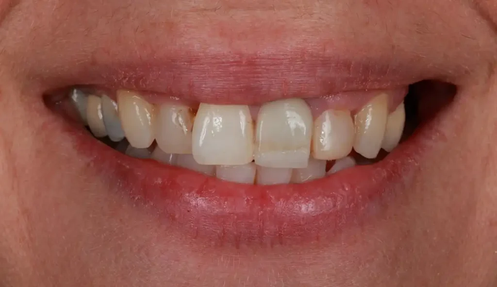 Before dental veneers application
