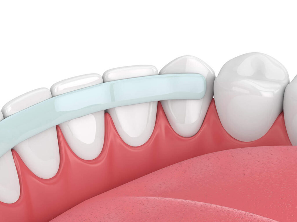 illustration of dental bonding