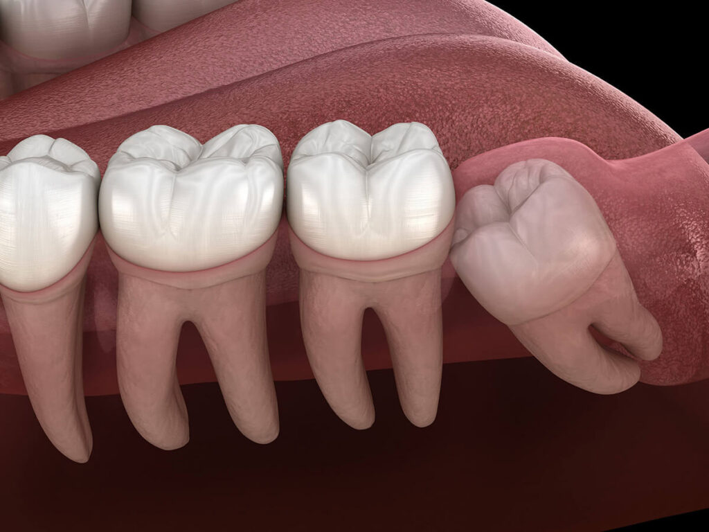 illustration of impacted wisdom teeth